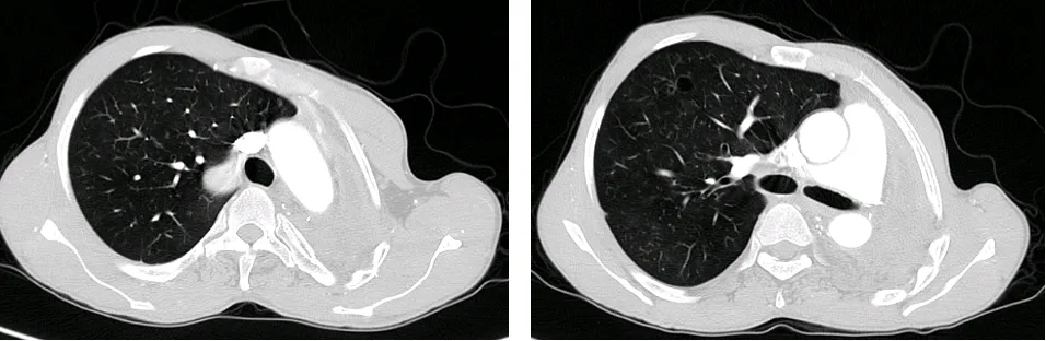 Figure 3. Chest computed tomography scan after left pneumonectomy and before liver transplantation