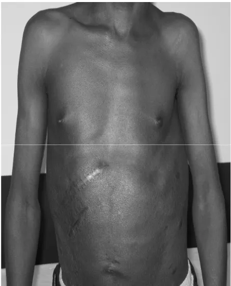 Figure 4. Minitransplant procedure with right subcostal incision after 12 months of follow-up