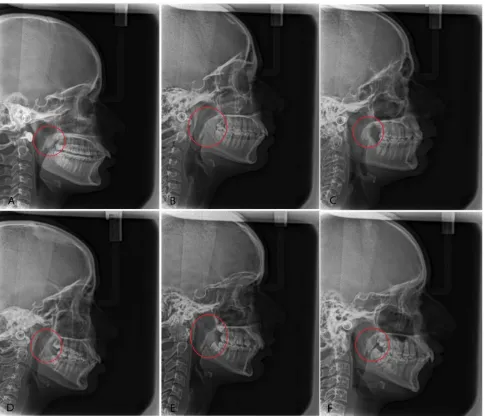 Fig. 1. Various morphological types of soft palate on lateral cephalograms.(A)Leaf shaped soft palate (B) Rat tail shaped soft palate  (C)Butt like soft palate (D) Straight line type soft palate (E) S-shaped soft palate (F) Crook shaped soft palate   