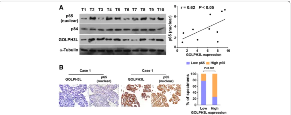 Fig. 6 Clinical relevance of GOLPH3L-induced NF-with the expression of GOLPH3L in 177 primary human ovarian cancer specimens