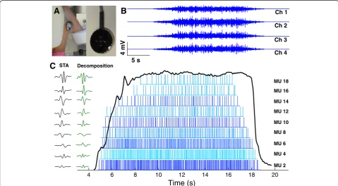 Figure 1 Surface EMG recording and decomposition. A: 5-pin sEMG sensor array. B: 4 channels of sEMG recorded from the first dorsalinterosseous muscle