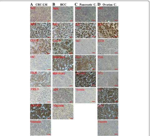 Fig. 3 Cells treated with exosomes isolated from cancer patient sera differentiated into the same lineages of the primary cancers.fibroblasts were treated for 3 weeks with medium containing exosomes isolated from the sera of patients with CRC-LM (( BRCA1-K
