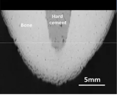 Fig. 4. X-ray scanner image of hard composite apatite/chitosan cement in bone cavity. Image obtained after applying computational image processing