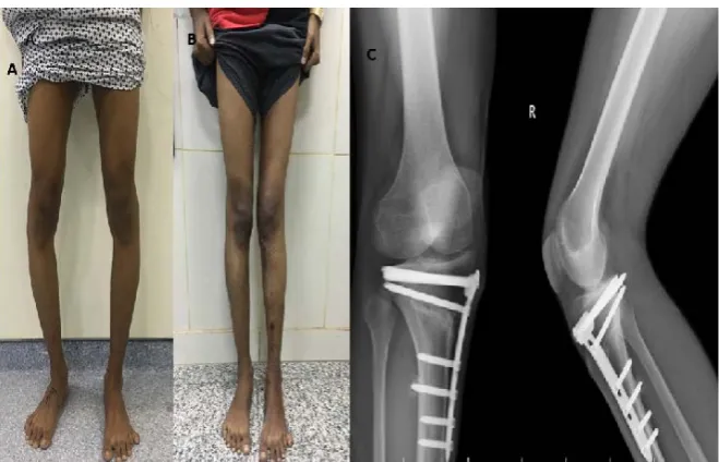Figure 1. (A) AP standing view of knee with severe varus deformity; (B) Oblique k wire directed to head of the fibular without penetration to lateral cortex, arrow line 1 cm on lateral cortex from joint line; (C) Left knee, medial view Locking Tomfix HTO p