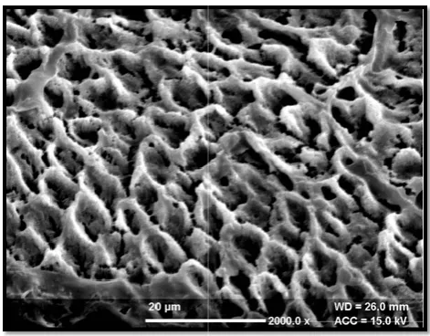 Figure 1. Type 1 and Type 2 etching patterns, wiFigure 1. Type 1 and Type 2 etching patterns, with more of type 1 etching patterns seen after etching the enamel setching patterns seen after etching the enamel surface with 37% phosphoric acidphosphoric acid 