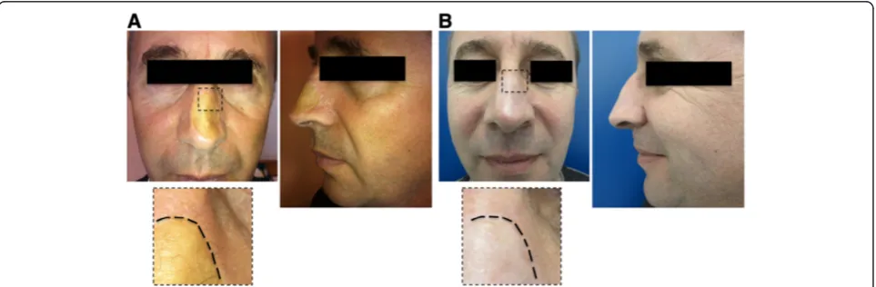 Figure 1 First patient undergone one step surgical skin regeneration. A 48 y.o. caucasian male presenting a wide (4×3 cm) depressed anddyschromic nasal skin-graft scar resulting from the resection of a sclerodermiform basal cell carcinoma