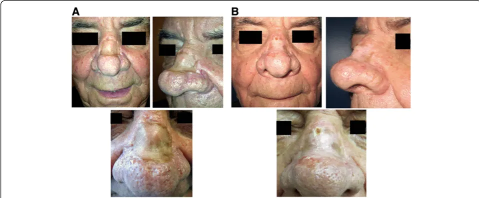 Figure 2 Second patient undergone one-step surgical skin regeneration. A 43 y.o. caucasian male, presenting a very similar skin graft scarsequela resulting from the resection of a sclerodermiform basal cell carcinoma