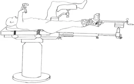 Figure 1 Positioning scheme of the legs in the hemilithotomy position. (iF Brouze).