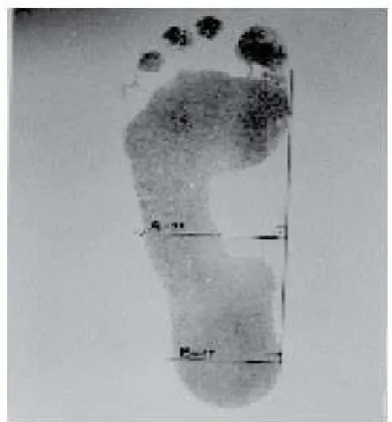 Figure 2. Lateral and Medial arch of foot  