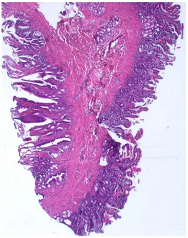 Figure 1. Intraoperative appearance of a duodenal membrane (arrow). The second part of the duode-num is opened longitudinally (with permission from Thieme, Stuttgart [15])