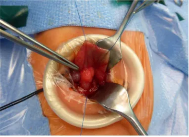 Figure 3. Annular pancreas. Constriction of the second part of the duodenum (with permission from Thieme, Stuttgart [15])