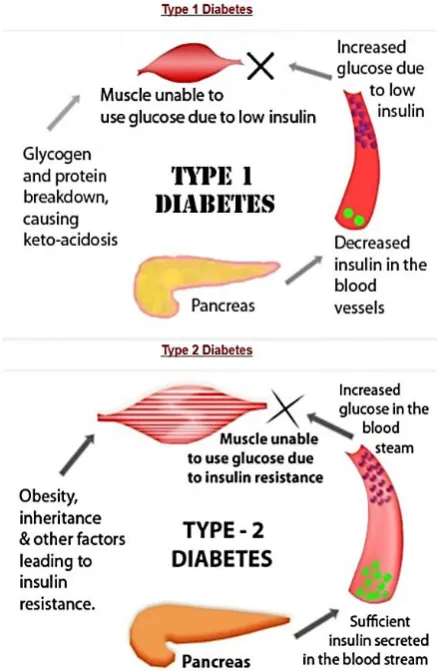 Figure 1. Type1 Diabetes v/s Type 2 Diabete  