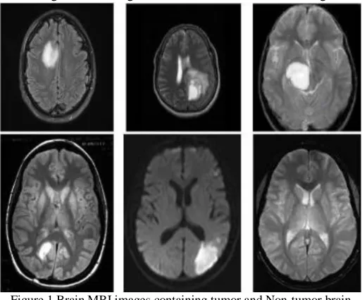 Figure 1 Brain MRI images containing tumor and Non-tumor brain image 