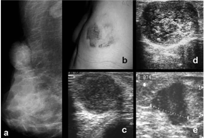 Figure 1. Unresolved outcomes of breast traumas: post-traumatic hematoma difficult to differentiate from mucinous carcinoma and medullary carcinoma