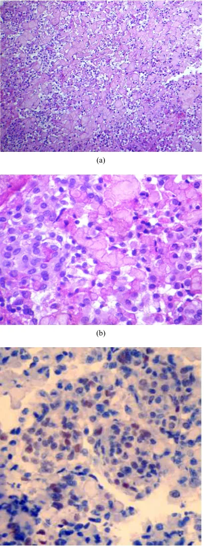 Figure 3. (a) Microscopically, the tumour is composed of patternless sheets of clear-cells in a collagen background 