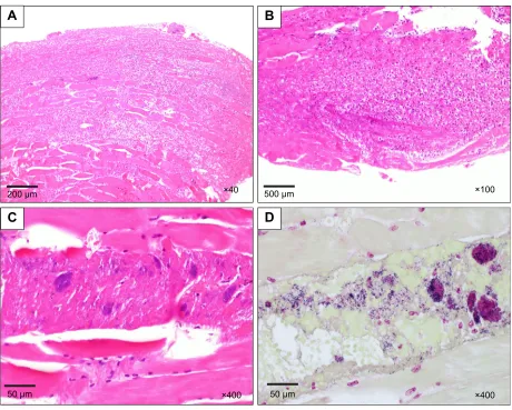 Figure 3 Pathological findings of excised skeletal muscle and fascia.Notes: (A–C) Acute inflammation with necrosis, consistent with necrotizing fasciitis; (D) Gram staining revealed a large number of Gram-positive cocci.