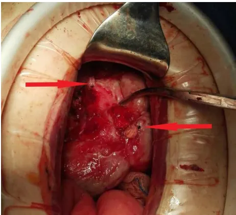 Figure 2 The horseshoe appendix was bundled and cut into two parts (arrow) to manage it side by side for severe adhesions in the appendiceal area.