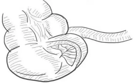 Figure 4 Frontally displaced mesentery (our case is of this type).