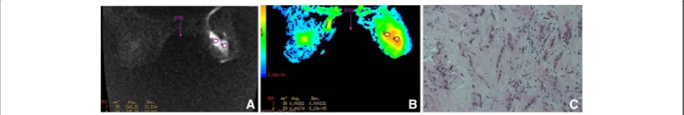 Figure 1 A representative case of benign breast lesion: sclerosing mastopathy (in a 53-year-old patient)