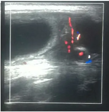Figure no.3A Bowel loop seen in the Inguinoscrotal region.  