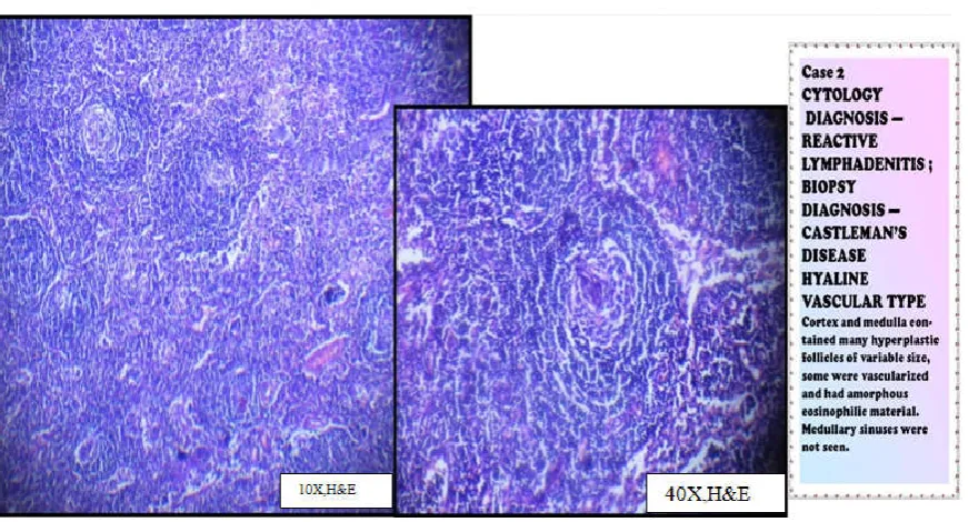 Figure 1. Gray zone lymphoma  