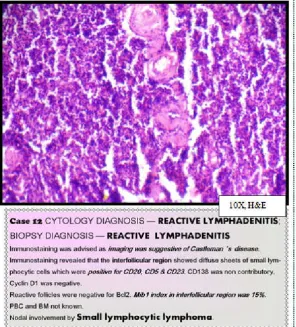 Figure 3. Small lymphocytic lymphoma    
