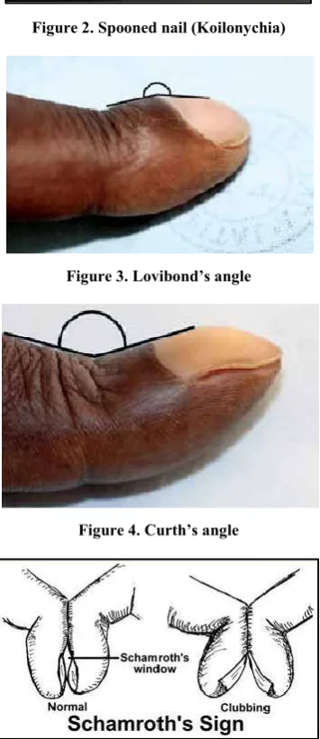 Figure 2. Spooned nail (Koilonychia) 