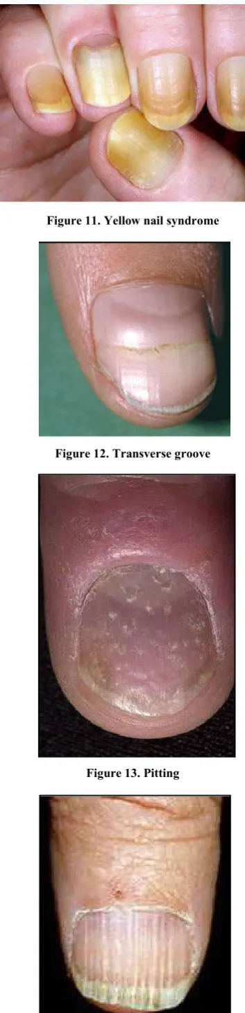 Figure 12. Transverse groove 