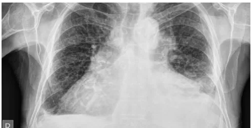 Figure 1. The 12 lead resting electrocardiogram (ECG) showing normal sinus rhythm with left ventricular hypertrophy (is tall R-wave in V6/V5 and tall S-wave inV1/V2) with normal QT intervals