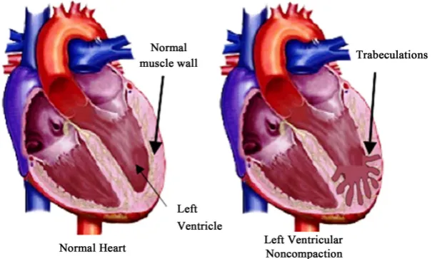 Figure 4. Diagram showing multiple deep trabeculations (multiple fingers like projec-tion) in the muscle wall of Left ventricle in LVNC [12]