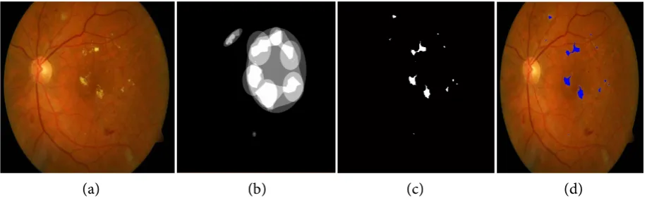 Figure 6. Result of the segmentation. Column (a) original image containing the exudates; Column (b) result of manual segmentation by experts; Column (c) segmented exudates; Column (d) seg-mented exudates reconstructed and superimposed on the original image