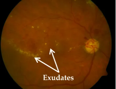 Figure 1. Retinal original image from DIARETDB1 dataset (arrows indicate exudates regions)