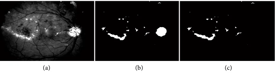 Figure 4. Result of segmentation procedure. (a) Enhanced image; (b) Result of ROIs segmented with EMT algorithm; (c) Detected exudates