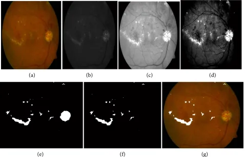 Figure 5. Result of segmentation procedure: (a) The starting image (from DIARETDB1 dataset which includes exudates; (b) The green channel image with poor contrast; (c) Is the Modified image after dynamic expansion with better contrast; (d) Is the enhanced 