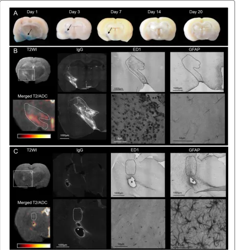 Figure 2 Edema build-up and resolution phase characteristicsalong the internal capsule up to the midline with high ADC values (similar pattern as in Figure 1, day 3)