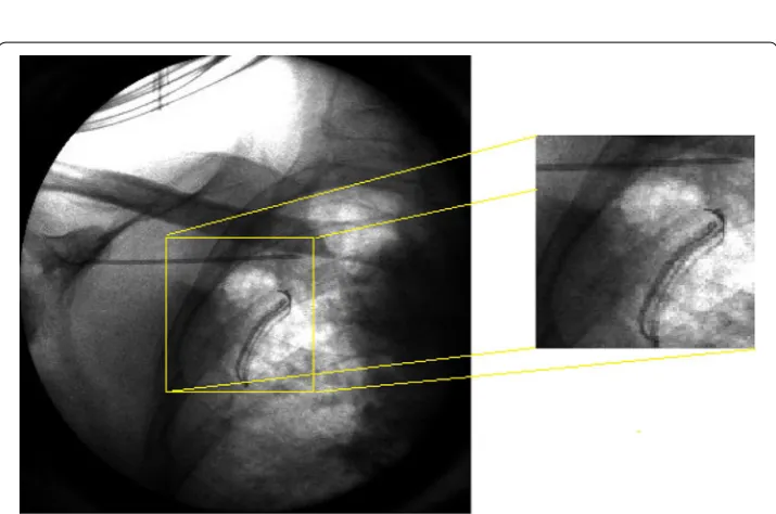 Fig. 15 Digital phantom with a moving rectangular insert. The red arrows indicate the moving direction of the insert over the consecutive frames