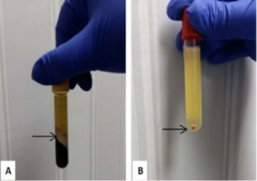 Figure 1. Vacuum gel separator tubes (figure 1A).  platelet pellet Vacuum gel separator tubes (figure 1A)