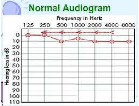 Table 3. Hearing threshold using BERA, (N=20) 