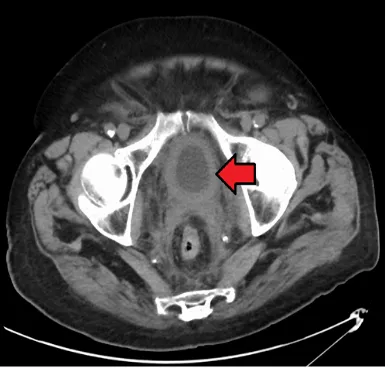 Fig. 1. colonoscopy neoformation rectus 