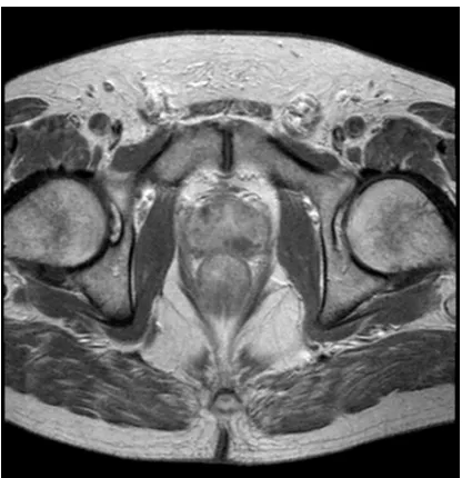 Fig. 4. RNM tumor rectum 
