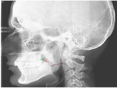 Figure 3. Green line represents distance between tongue at soft palate at junction, red line represents distance between tongue and soft palate at maximum width and pink line represents distance between tongue and soft palate at tip and blue line represents distance between tongue and pharynx 