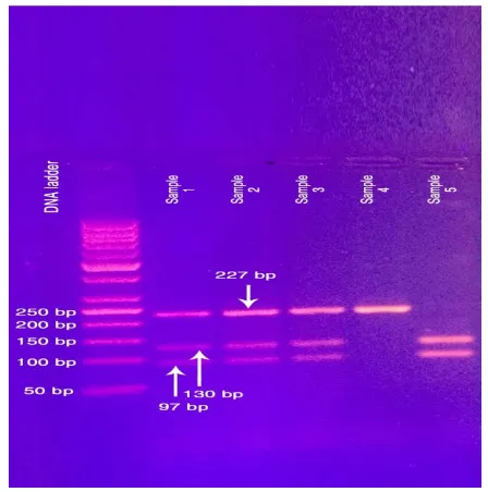 Figure (1). Agarose gel electrophoresis of CRP rs 1205 of five samples. Lane 1: 50 bp molecular marker, lane 2,3,4: (GA) heterozygote genotype, lane 5: (AA) minor homozygote genotype, lane 6: (GG) major homozygote genotype  
