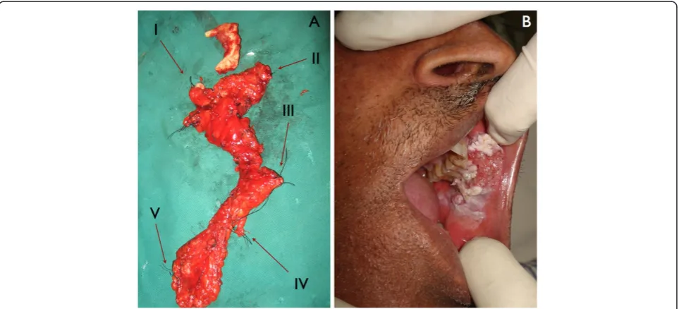 Figure 1 (A) demonstrates the margins of all resected specimens of primary tumor and cervical lymph nodes