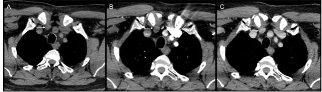 Figure 1. Beam hardening artifact limits adenoma detection on arterial phase. Axial noncontrast (A), arterial (B), and venous (C) CT images showed beam hardening artifact from the IV contrast obscuring the right superior mediastinal adenoma (arrow)