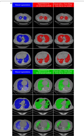 Fig. 6 Examples of segmentation at axial slices (In each sub-figure, there are three columns: the left the left column shows the results of manual segmentation of lung field including both lung parenchyma and lesions; the middle column presents the results