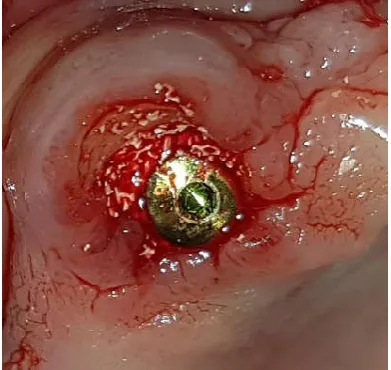 Figure 1: Preserved buccal root fragment after sectioning 