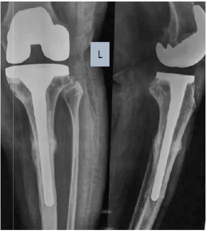 Figure.1 . Pre operative x.1 . Pre operative x-ray AP and Lateral view of Case 1 