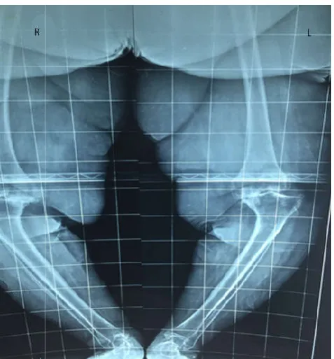 Figure 4. pre operative x-ray of Case 2  