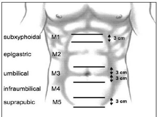 Figure 1  : Classification of midline incisional hernias 