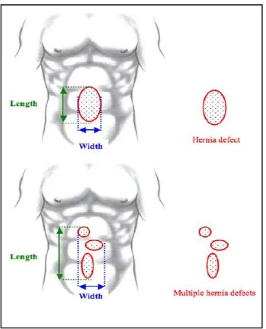 Figure 3 : Definition of the width and the length of incisional  hernias for single hernia defects and multiple hernia defects 
